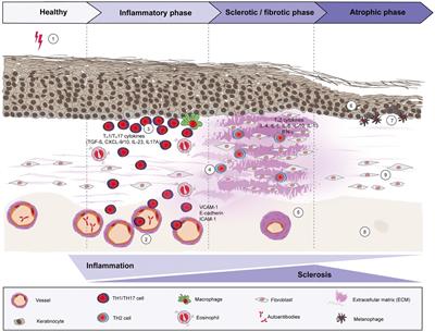 Morphea: The 2023 update